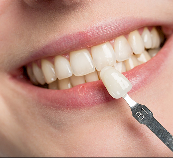 Gute Veneers Gute Veneers