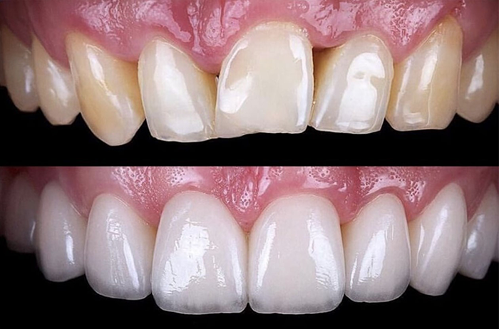 Günstige und qualitative Veneers Günstige und qualitative Veneers